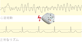 心室細動(VF)の心電図と正常なリズムの心電図